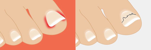 ортониксия спб, коррекция вросшего ногтя, лечение вросшего ногтя в СПб